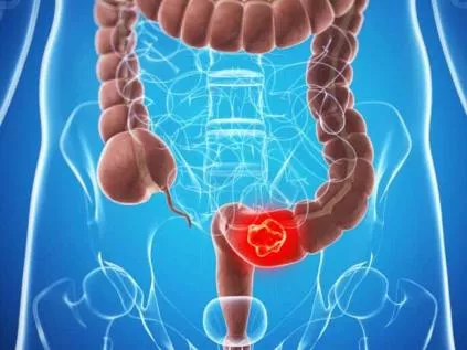 Câncer de Intestino: Identificando os Sinais Precoces