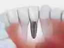 Implante Dentário: Custos, Indicações e Processo