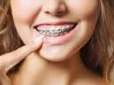 Cores de Aparelho Dental: Um Guia Completo para Personalizar Seu Sorriso