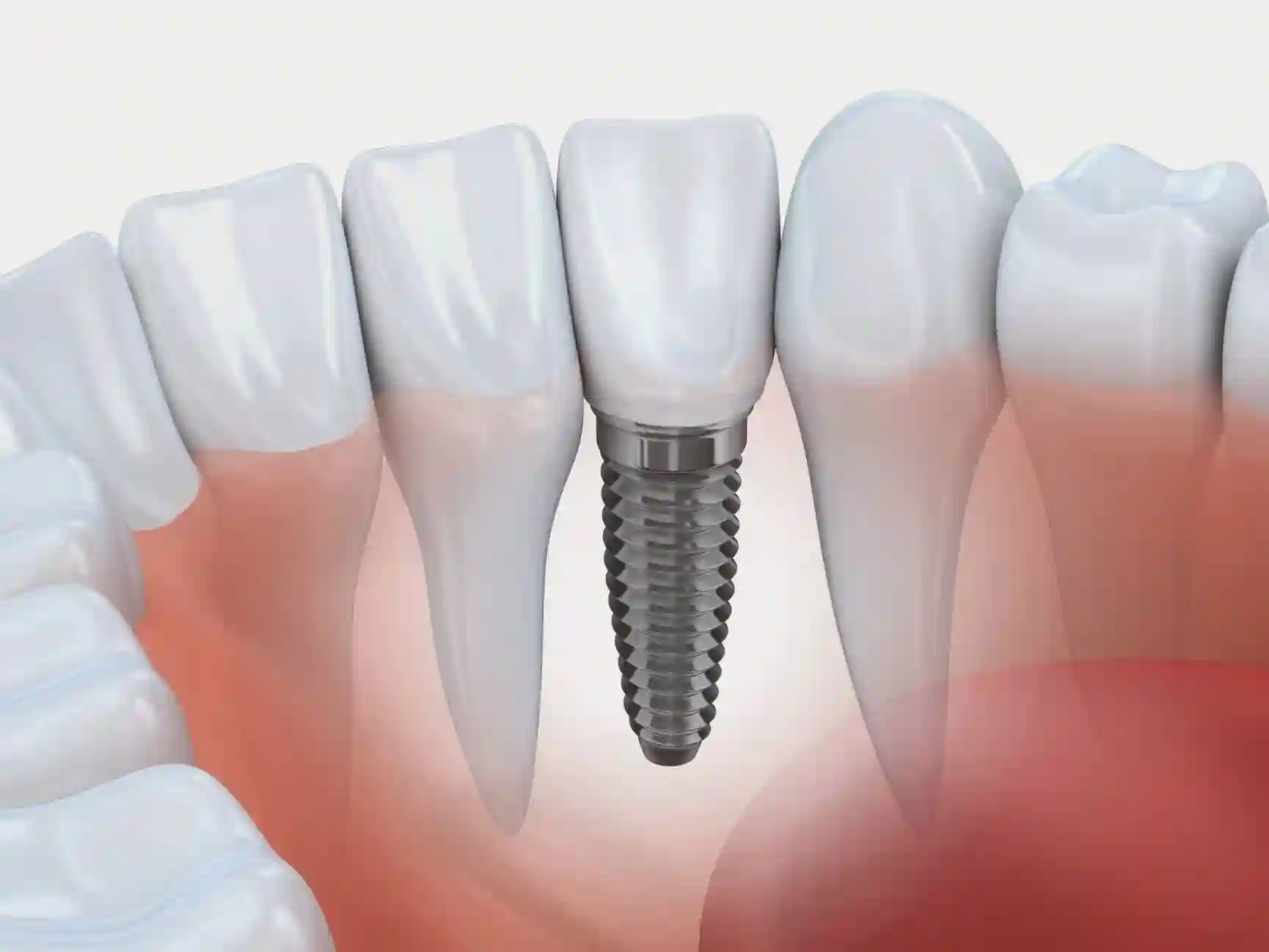 quanto custa um implante dentário