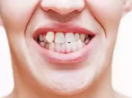 Dente encavalado: causas e opções de tratamento