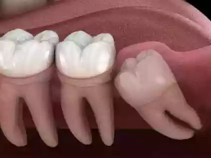 Extração de dente: quando é de fato necessária?