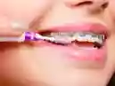 Quais as cores de aparelhos dentários que não desbotam?