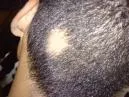 Alopecia Areata: O que é, causas e como lidar com a queda (Guia Real)
