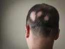 Alopecia Areata: O que é, Causas e Minha Jornada Real
